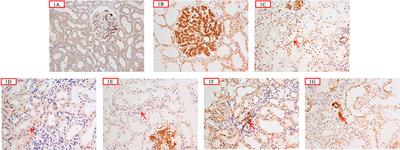 The Spectrum of C4d Deposition in Renal Biopsies of Lupus Nephritis Patients